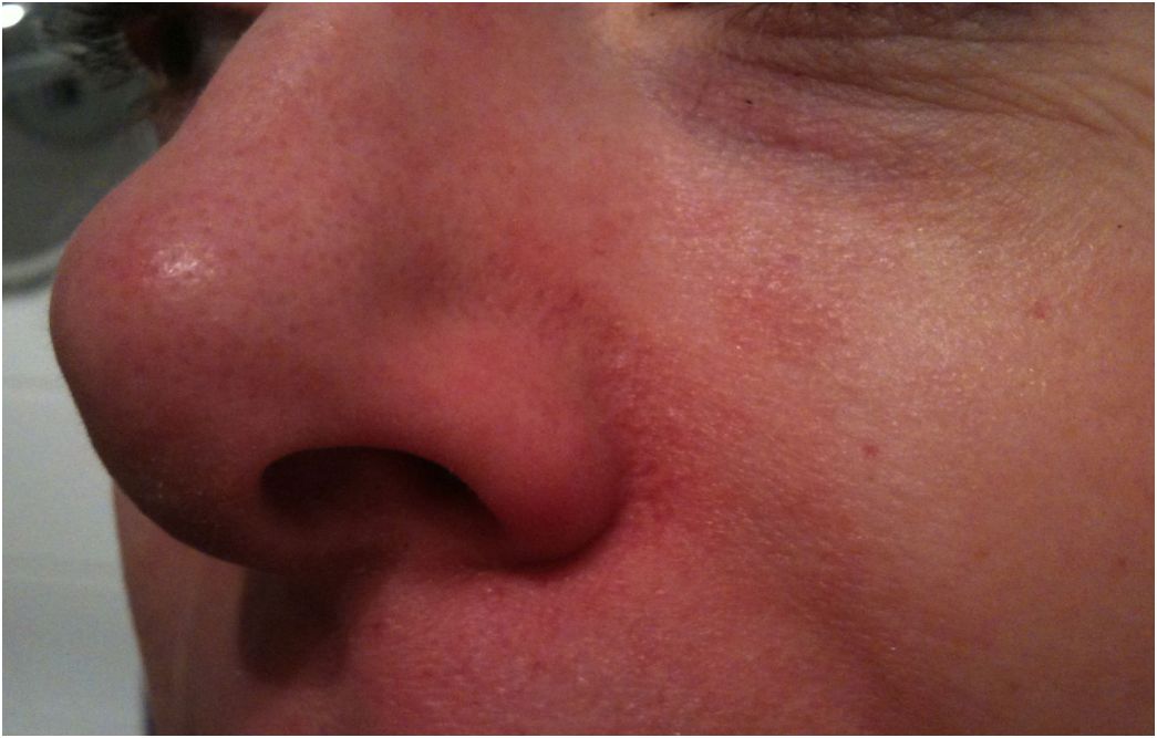 snor meten Ciro Expertvraag: Mijn neusvleugels zijn altijd rood, hoe komt dat?