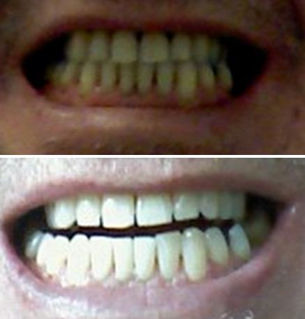 Alles Wat Je Moet Weten Over Tanden Bleken Of Bleachen - Voeren thumbnail