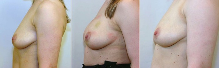 borstvergroting met lipofilling