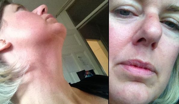 vlnr: mijn hals na tien weken, en het litteken onder de neus is ook bijna geheel weg