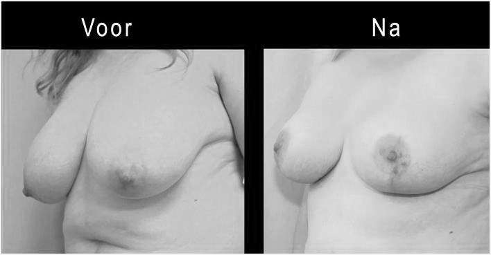 voor en na borstverkleining