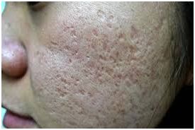 box scars