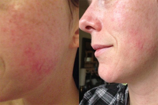 Links: voor de behandeling, Rechts: na de behandeling