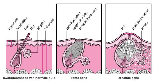 talgklier en acne