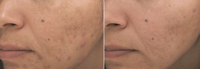 Acne behandeling met PCA skin, voor en na.