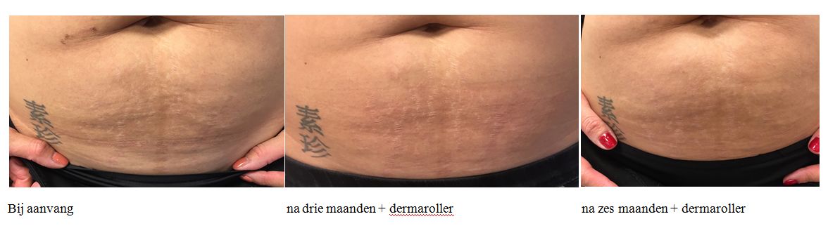 eucerin striae olie met dermaroller resultaat