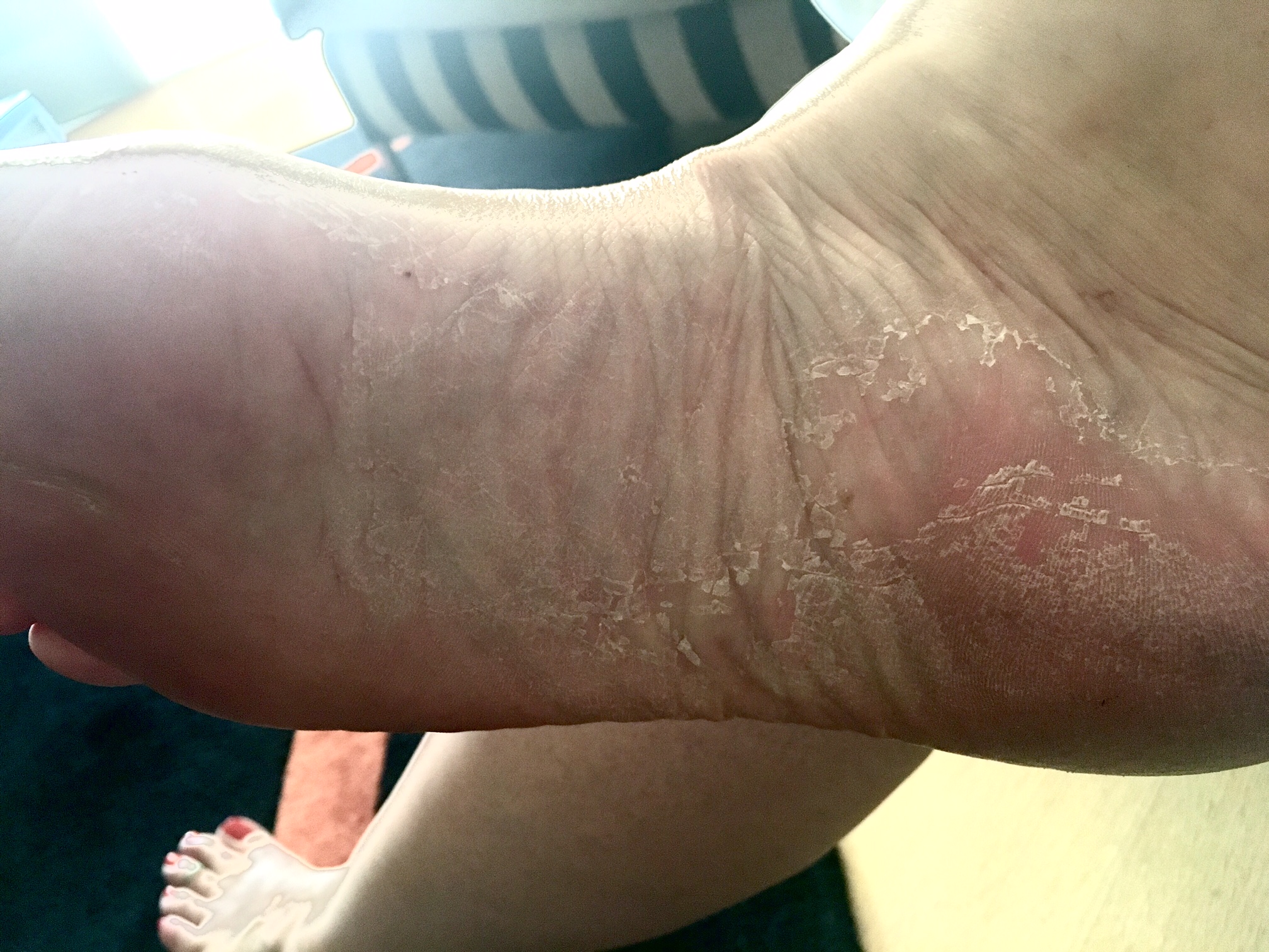 Een week na de peeling schilfert de hele voet bij Monique