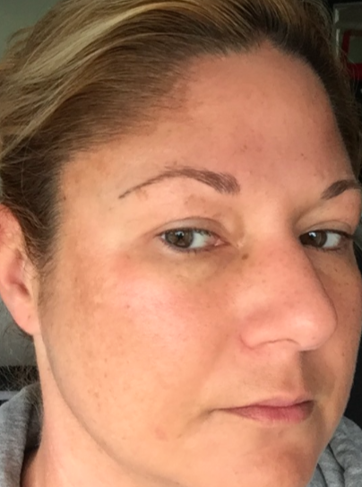 Esthers huid ruim tien dagen na de peeling.