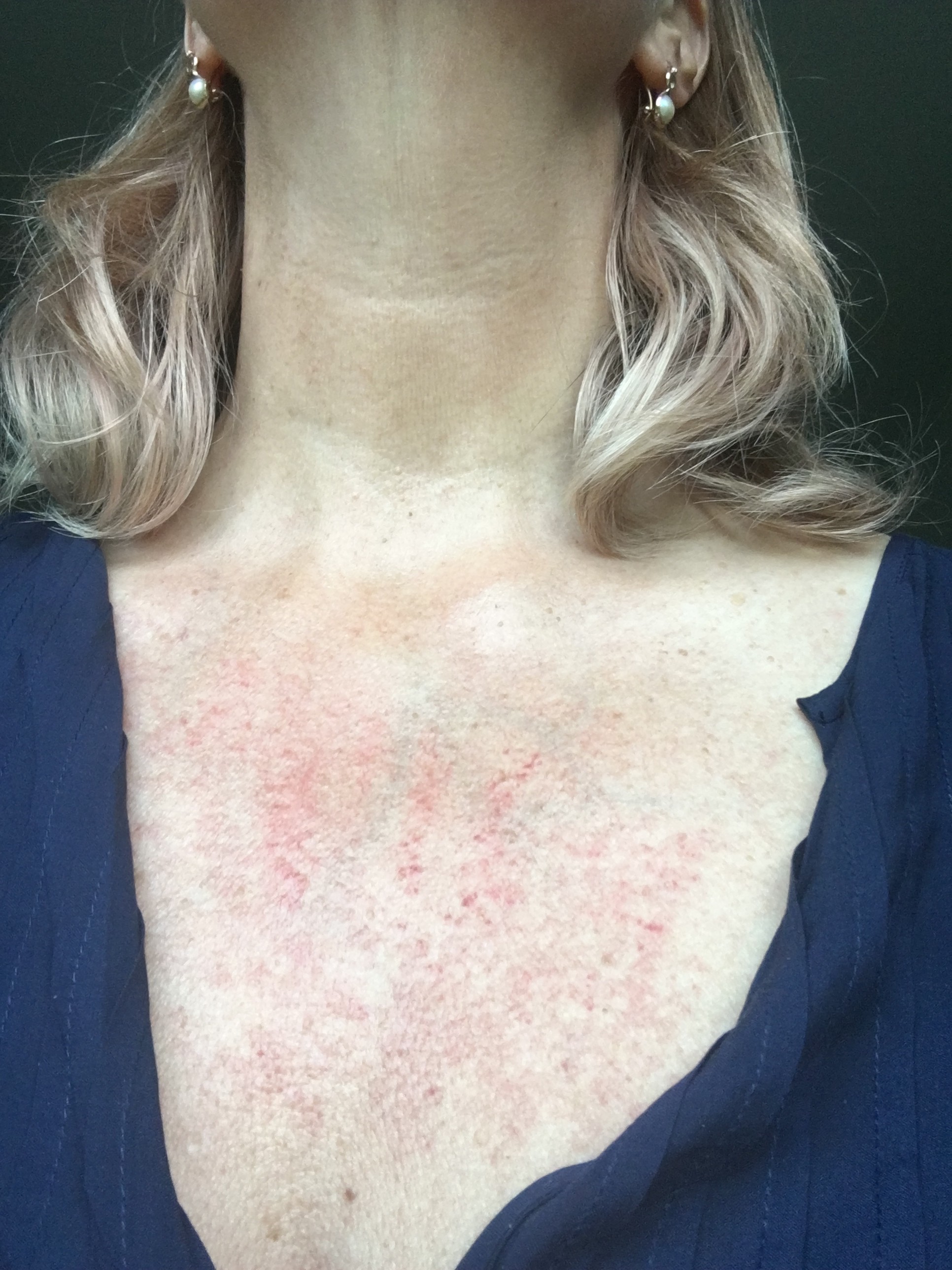 rode huid na meso met skinboost, de dag erna