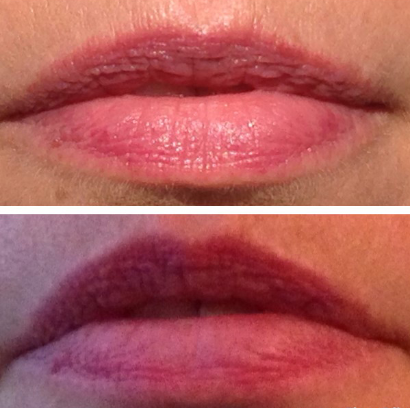 Filorga Nutri-Filler Lips na 7 dagen