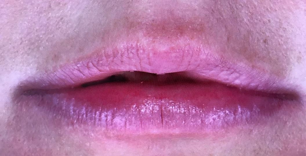 Genezen lip na behandeling met Hyaluronidase medicijn