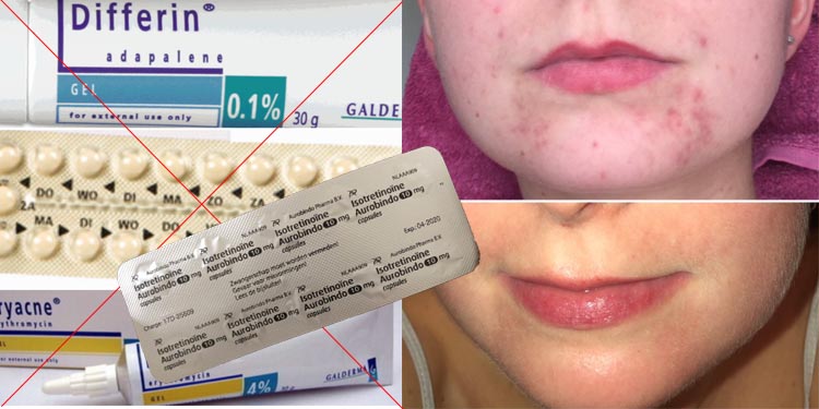 Vergemakkelijken Vechter hemel Verhaal: Fabienne kreeg Roaccutane tegen haar zware acne