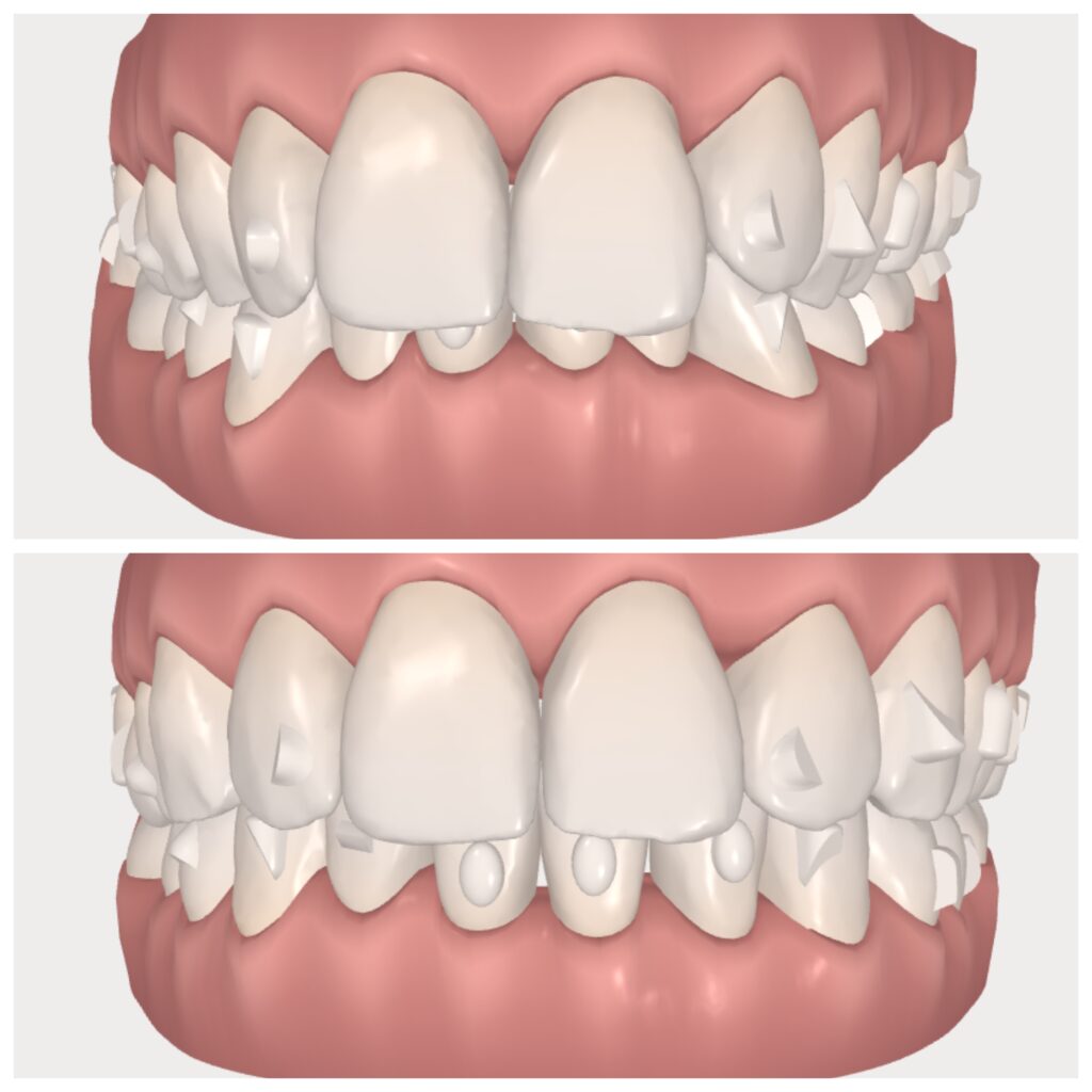 Catastrofaal vluchtelingen nachtmerrie Monique: Op je 53ste een Invisalign doorzichtige beugel + video