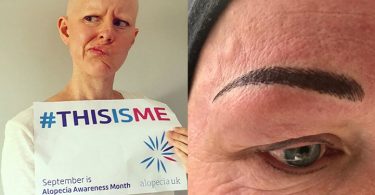 PMU alopecia