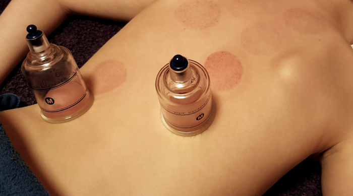 cupping