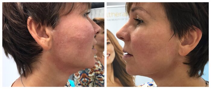 net na behandeling ultherapy da vinci clinic beerse