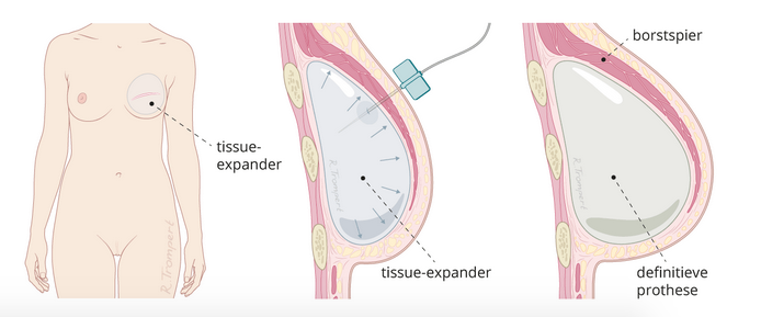 tissue expander na borstreconstructie