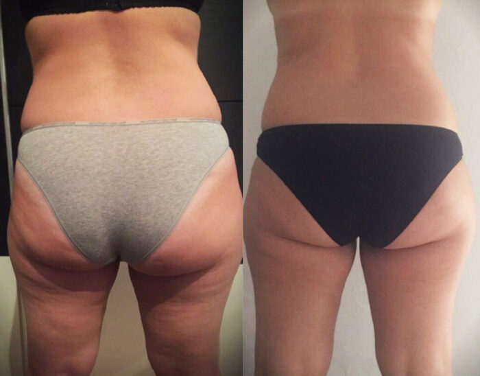 cellulite verminderen met adipologie