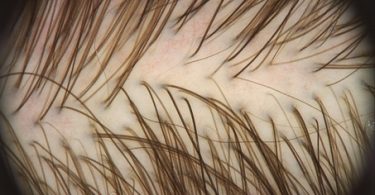 haarverlies