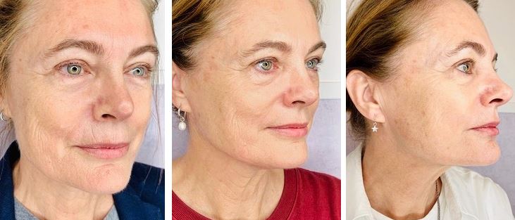 voor na foto's pascaud contour beautyjournaal