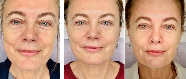 voor na kuur pascaud contour beautyjournaal