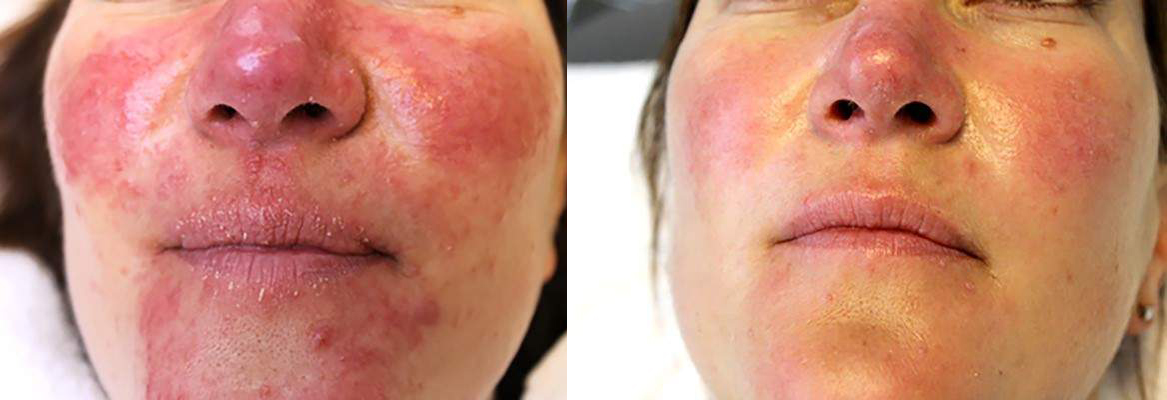 rosacea