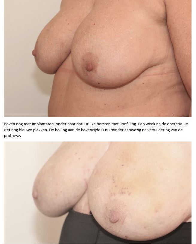 boven voor en na lipofilling en prothese verwijdering