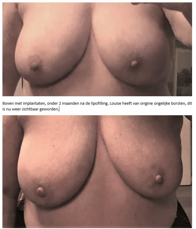 borsten voor en na lipofilling