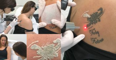 pico laser tatoeage amstelzijde