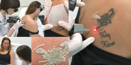 Supersnel! Weg is Ilonka's tatoeage met PicoSure
