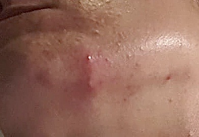 acne marieke