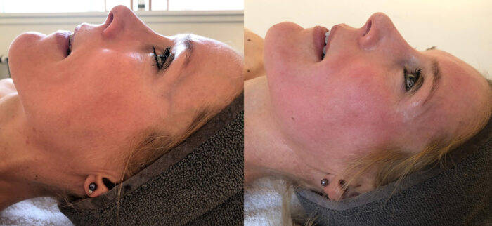 resultaat bindweefselmassage