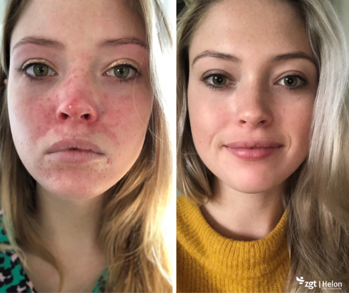 rosacea