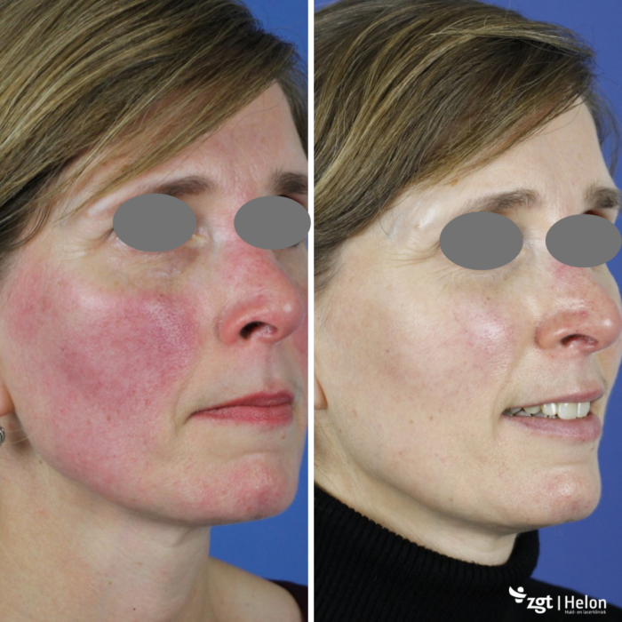 rosacea