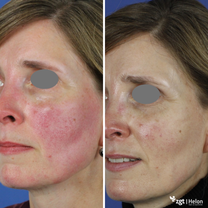 rosacea