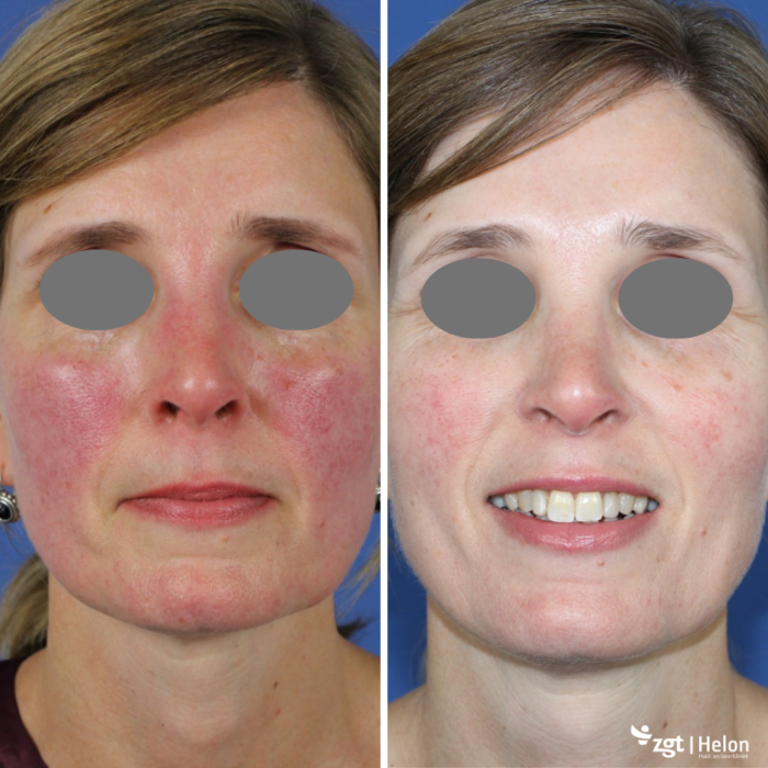 rosacea