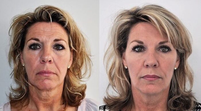 Voor en na liquid facelift