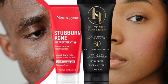 preambule emulsie koepel Dit is Amerikaans advies voor acne op de donkere huid!