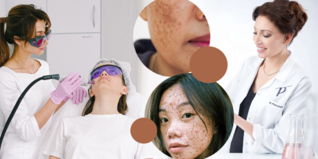 Spreekuur met Mardge Pascaud: helpt IPL wel bij melasma?