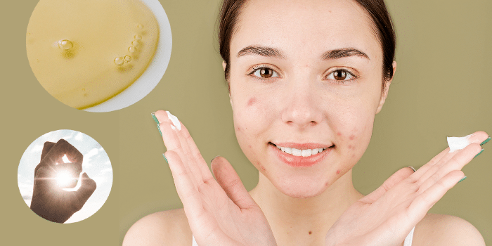 Acne? Sofie Dewitte geeft tips bij het kiezen van een zonnecrème voor jouw huid!