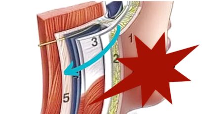 Verslapt ultrasound je huid juist meer?