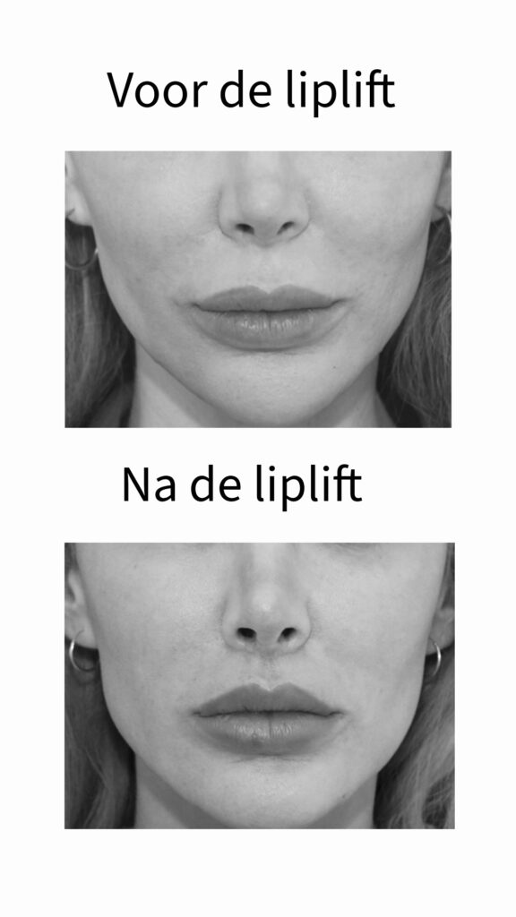 mondveroudering liplift beautyjournaal frank niessen