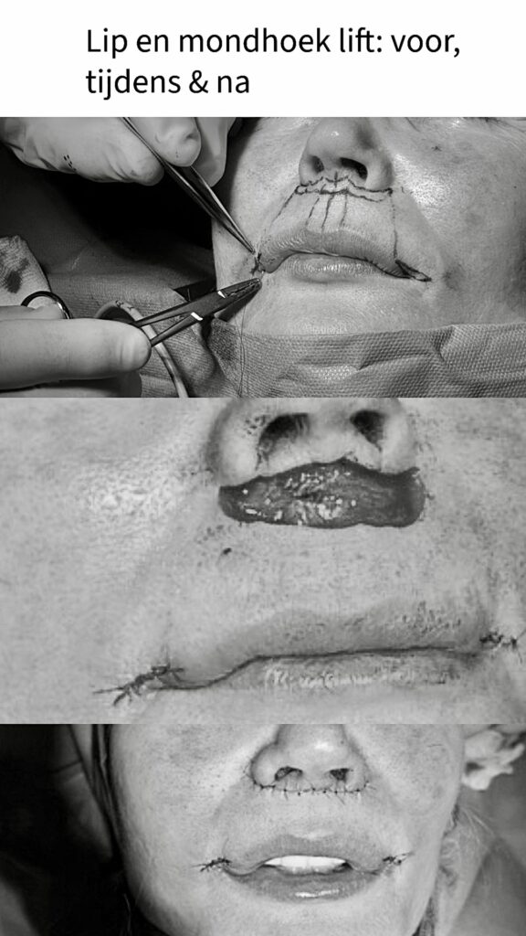 liplift en mondhoek lift beautyjournaal frank niessen