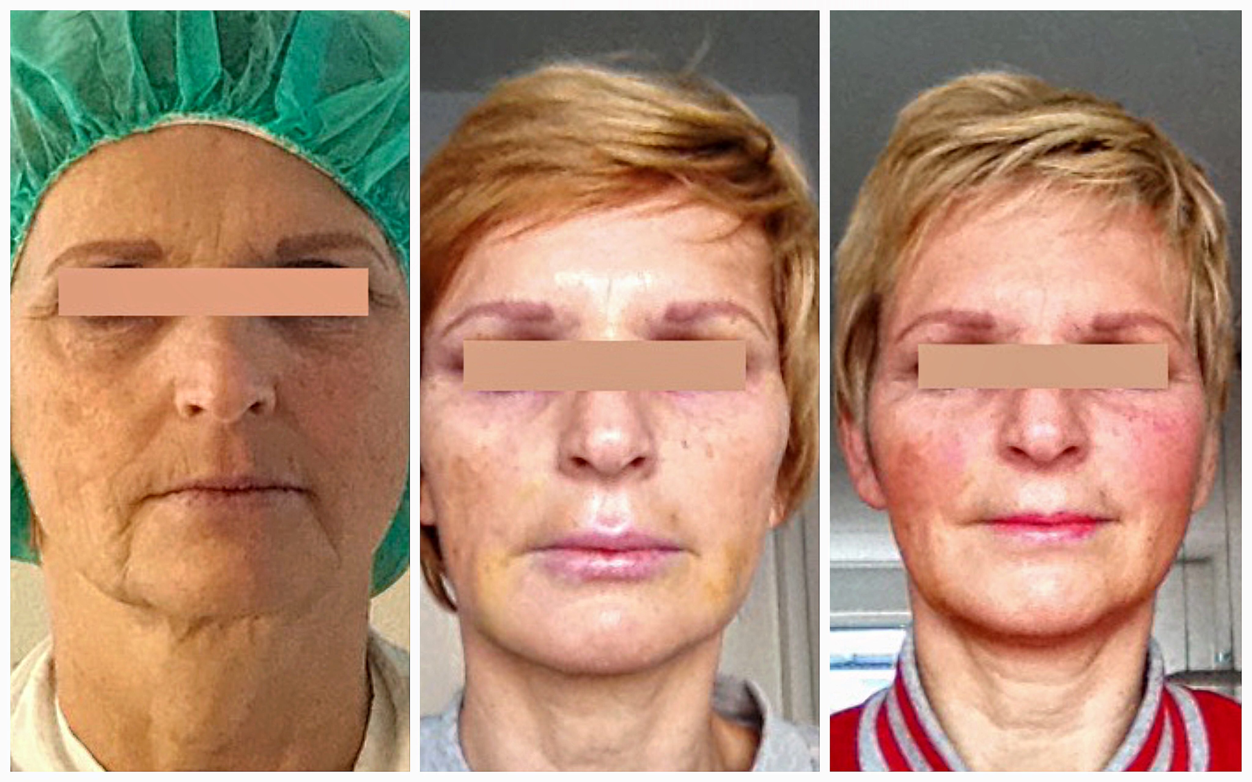 Lipofilling van het gezicht. Links op de foto is voor de behandeling, rechts is na behandeling. De jeugdigheid van het gezicht is helemaal terug incluis een frisse huid.