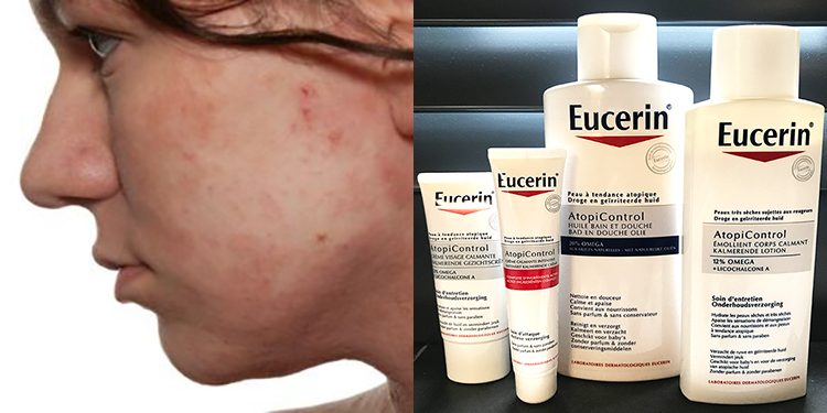 Homepage Eucerin AtopiControl atopisc eczeem