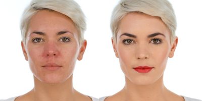 Homepage Lisa Eldridge Rosacea
