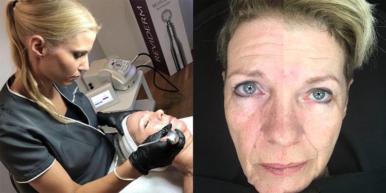 Homepage Micro-Needling Sylvana