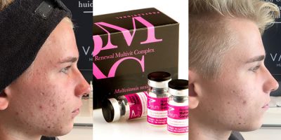 Homepage PBSerum Maaike Helmond Acne