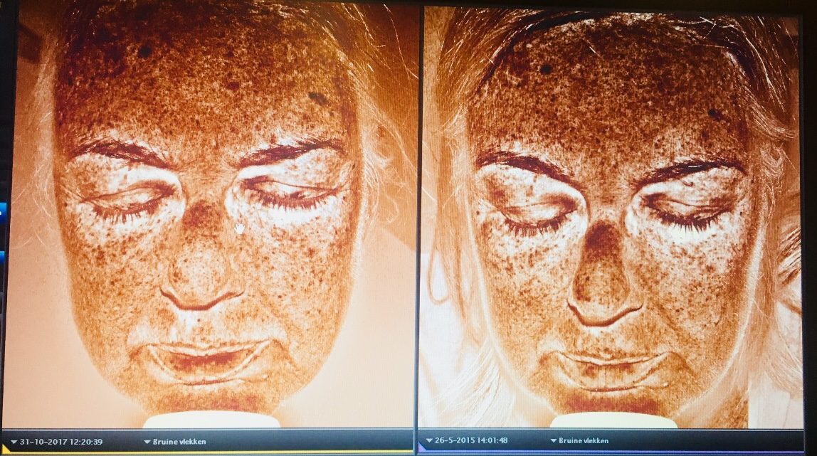 Het pigment in mijn huid. Links op de foto de stand van zaken in  oktober 2017, rechts in mei 2015.