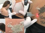 pico laser tatoeage amstelzijde